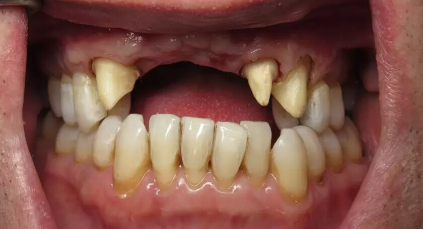 Mất 4 răng cửa liên tiếp để lại hậu quả nghiêm trọng đối với sức khỏe