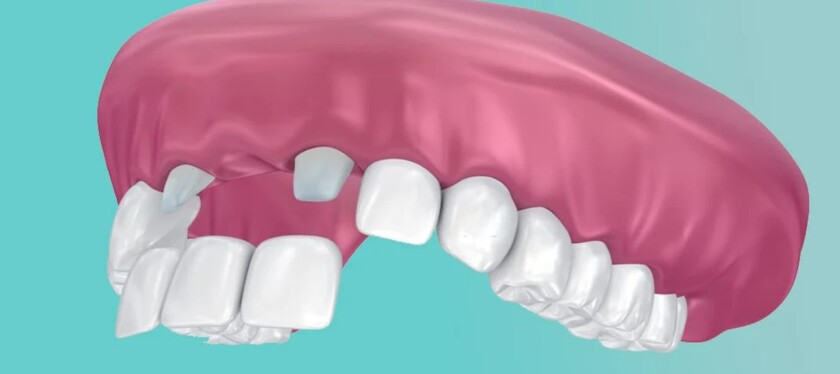 Cầu răng sứ chưa phải là phương pháp tối ưu để khắc phục tình trạng mất 4 răng cửa