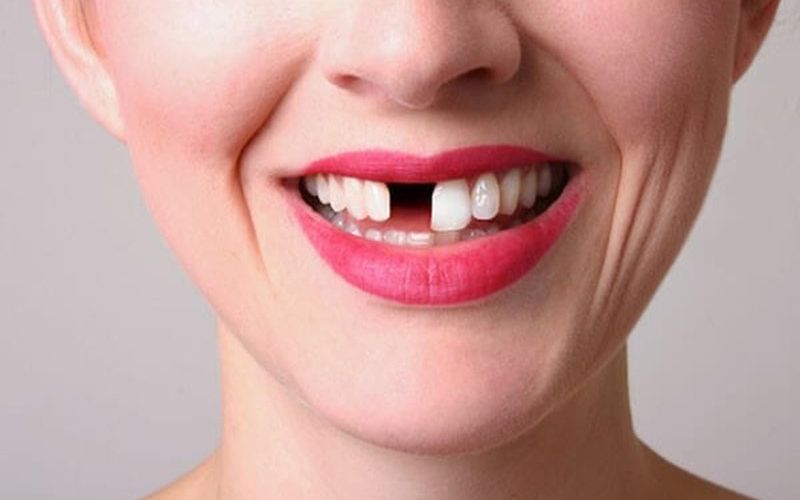 Hậu quả của mất răng có thể bạn chưa biết?