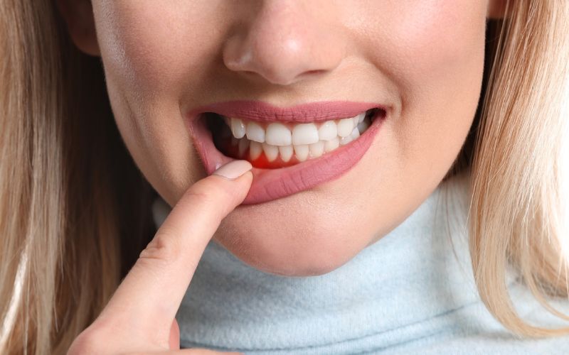 Bệnh viêm nha chu nếu không được chữa trị sẽ dẫn đến tình trạng mất răng