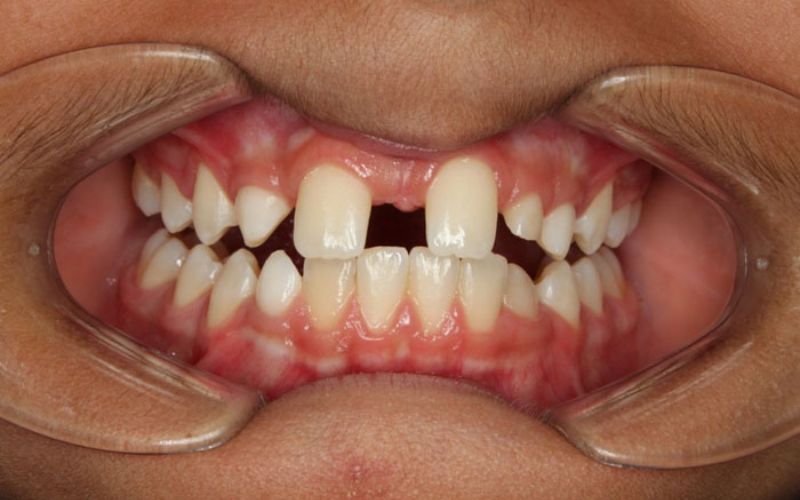 Thiếu răng bẩm sinh do yếu tố di truyền gây mất răng 