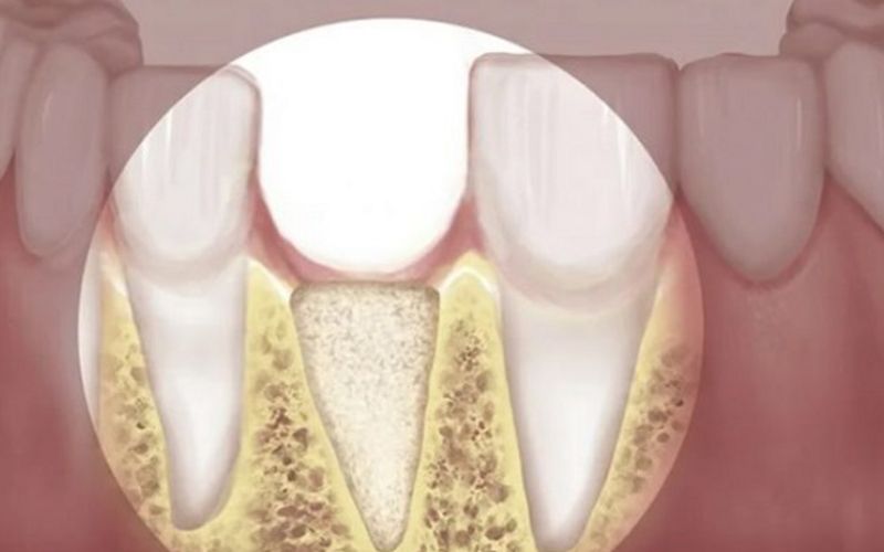Mất răng gây tiêu xương ổ răng
