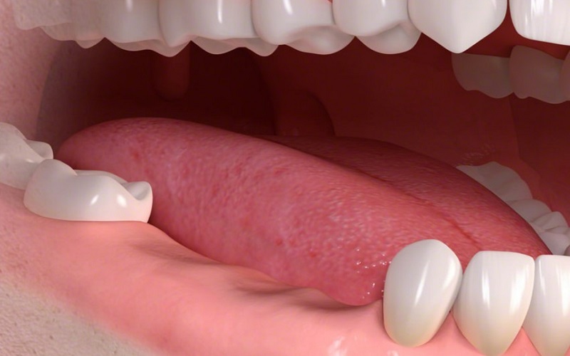 Mất răng bao lâu thì bị tiêu xương hàm?