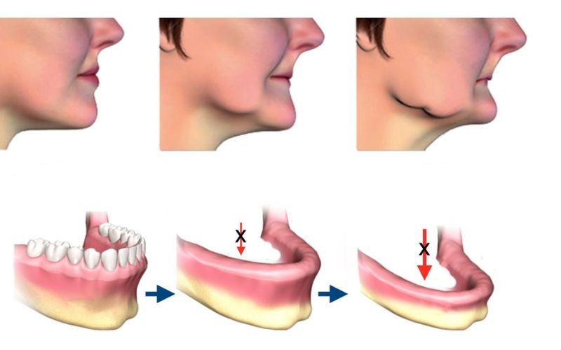 Tiêu xương hàm khiến răng cho người bệnh tự ti vì mất thẩm mỹ