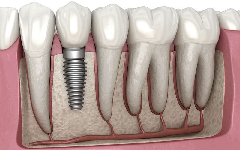 Sử dụng phương pháp cấy ghép Implant để khắc phục tình trạng tiêu xương