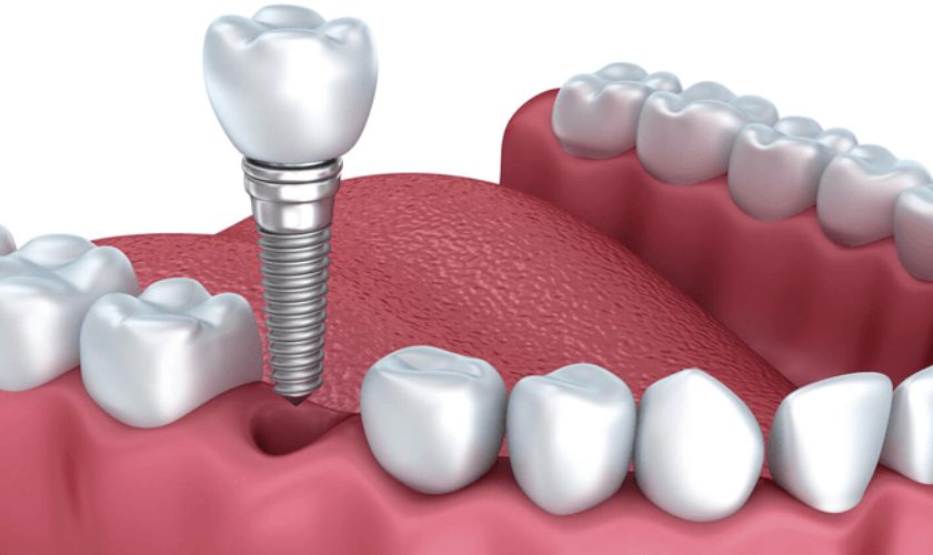 Tiêu xương hàm làm ảnh hưởng đến quá trình cấy ghép Implant do ghép thêm xương