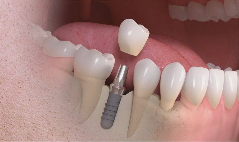 Cấy ghép Implant - giải pháp khắc phục mất răng bị lệch mặt hiệu quả cao