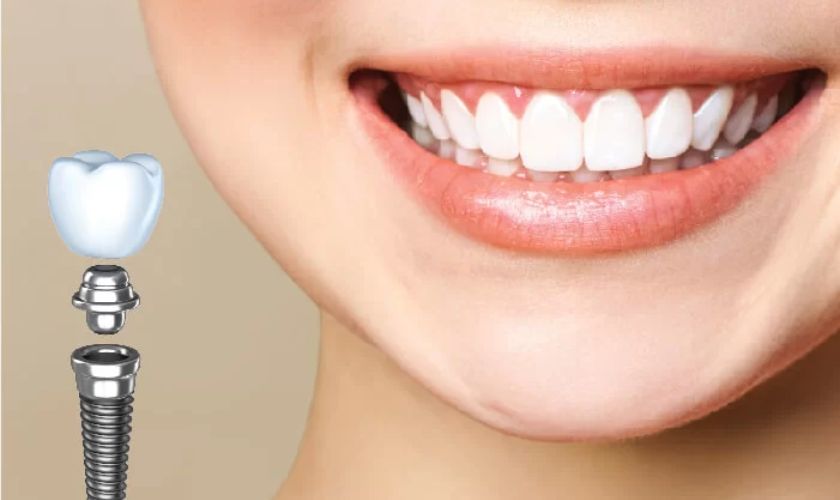 Tuổi thọ răng Implant rất bền nếu bạn biết chăm sóc đúng cách