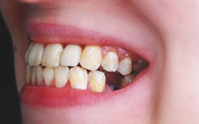 Người bị mất răng có niềng răng được không? 