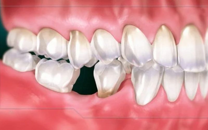 Nếu mất răng lâu lăm khả năng cao không thể niềng răng