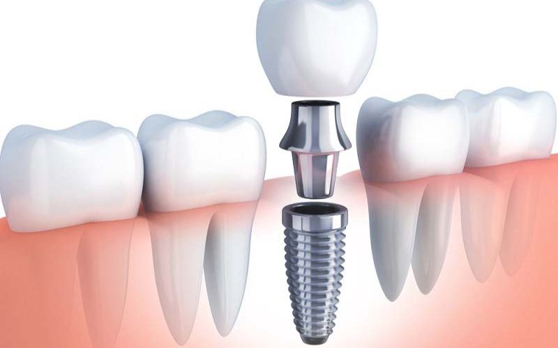 Lựa chọn cấy ghép Implant để khắc phục tình trạng mất răng