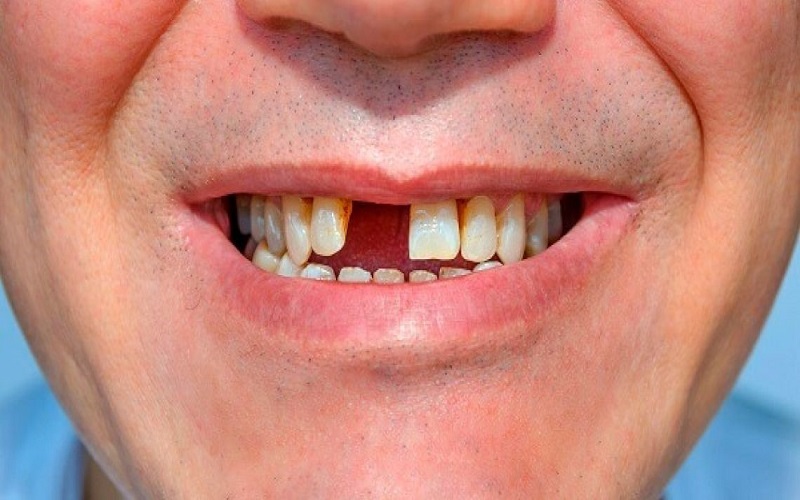 Phục hình răng cửa bị mất bằng phương pháp nào?