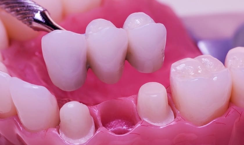 Cầu răng sứ là phương pháp phục hình răng cố định được nhiều người lựa chọn