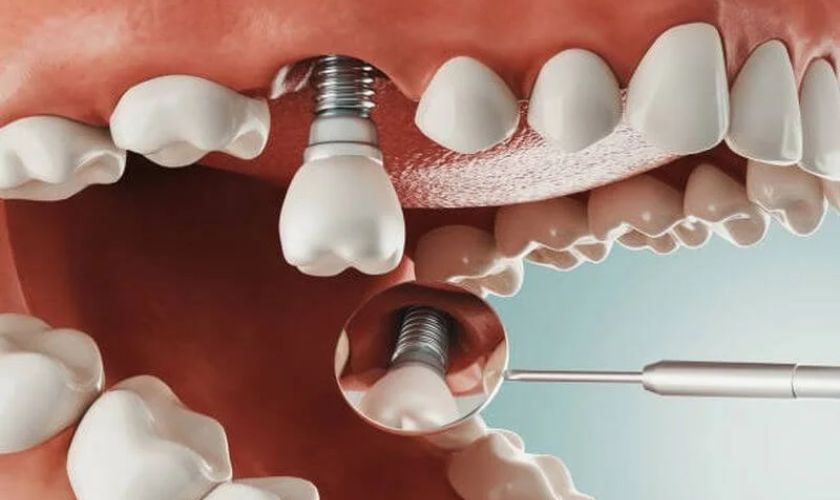 Phương pháp trồng răng Implant