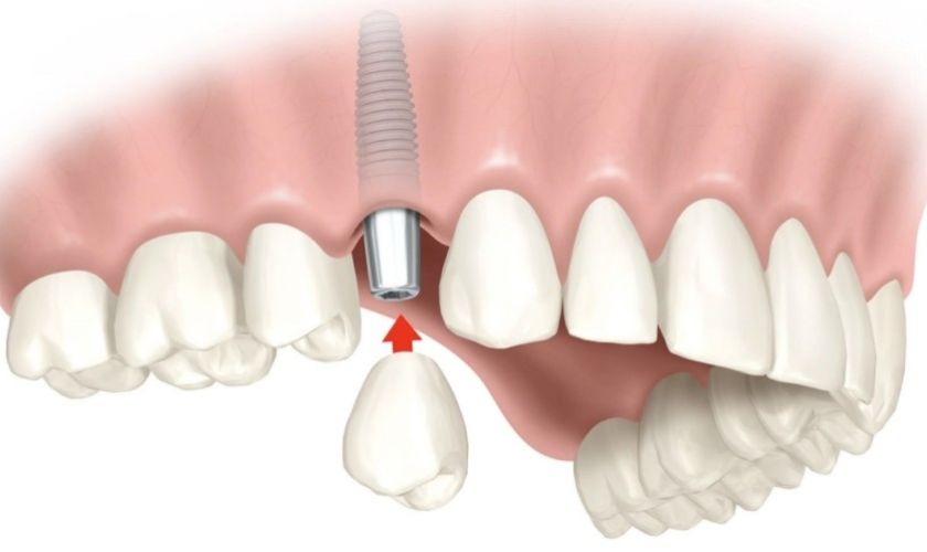 Trồng răng Implant có tuổi thọ cao nếu bệnh nhân biết chăm sóc đúng cách