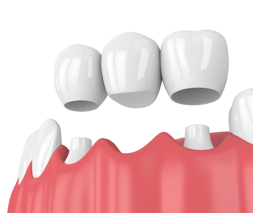 Làm cầu răng sứ không thể ngăn ngừa tình trạng tiêu xương hàm