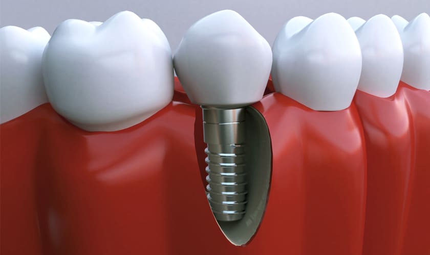 Răng implant có nhiều ưu điểm vượt trội