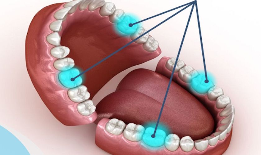 Răng số 6 bao gồm: men răng, ngà răng và tủy răng