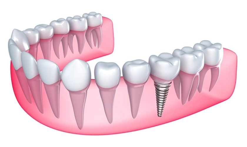 Cấy ghép Implant giúp ngăn ngừa tình trạng tiêu xương hàm