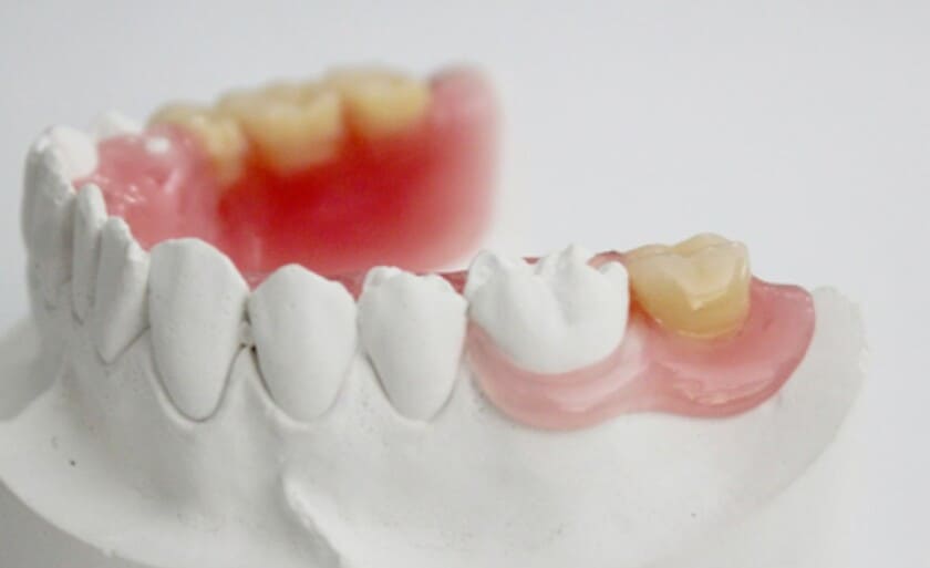Răng giả tháo lắp có thể tháo ra hoặc lắp vào khi đánh răng, ăn uống và nghỉ ngơi