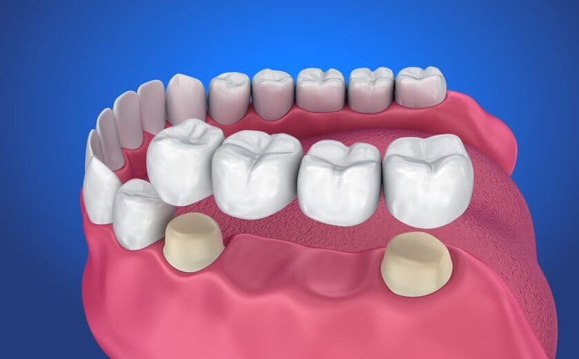 Phục hình răng số 7 bằng cầu răng sứ chỉ được thực hiện khi răng khôn chắc khỏe