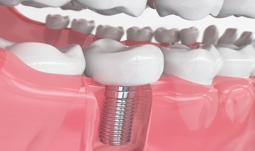Trồng răng implant được coi là giải pháp tối ưu để thay thế cho chiếc răng số 7 bị mất