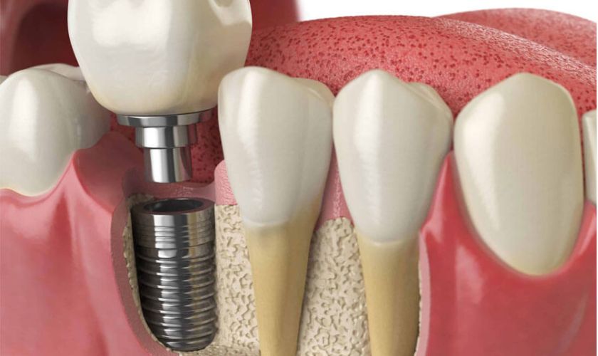 Cấy ghép Implant là phương pháp tối ưu giúp ngăn ngừa tình trạng mất răng số 7