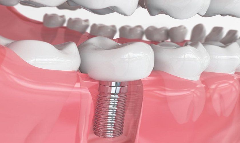 Trồng răng Implant