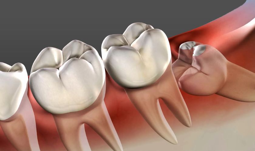 Răng số 8 mọc lệch sẽ làm tổn thương răng bên cạnh