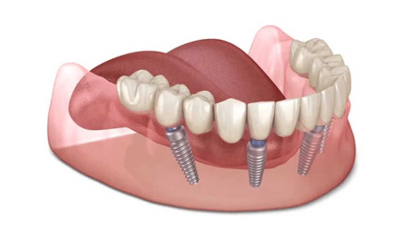 Máy khoan đặt trụ Implant giúp việc cấy ghép trở nên dễ dàng hơn