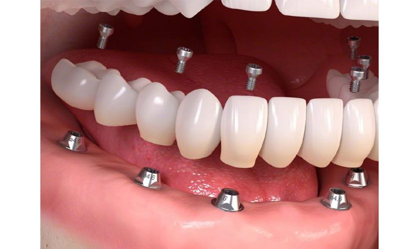 Không khoan quá mức Implant cho phép