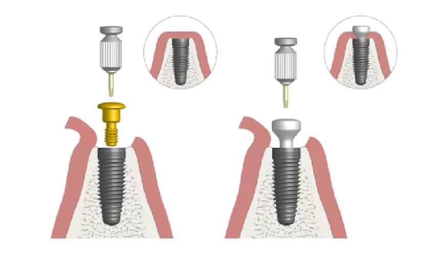 Trụ Implant