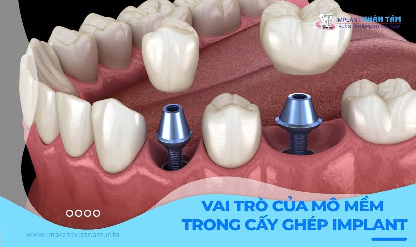 Mô mềm đóng vai trò gì trong cấy ghép Implant?