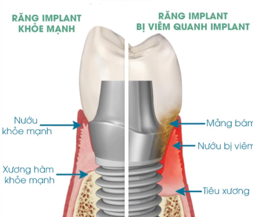 Mô mềm đóng vai trò quan trọng trong cấy ghép Implant