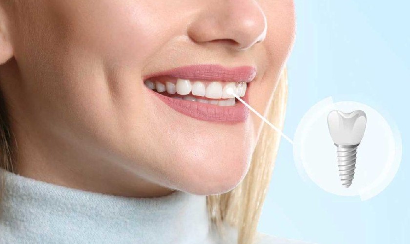 Mô mềm bao phủ trụ Implant, đảm bảo thẩm mỹ