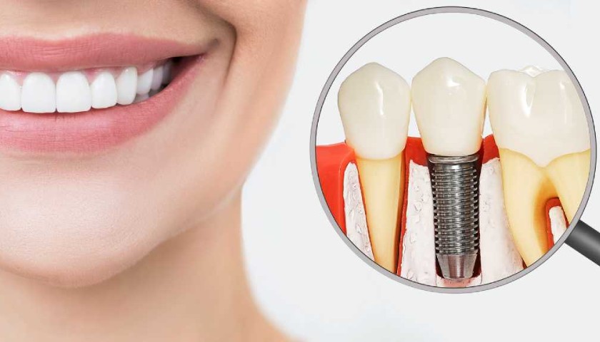 Mô mềm cần phù hợp với kích thước và vị trí của Implant