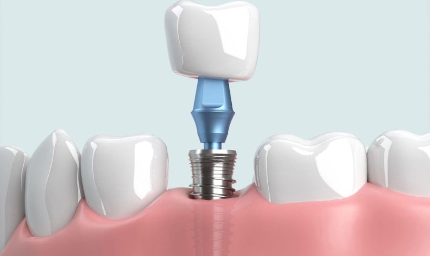 Mô mềm cần đảm bảo khả năng bám dính tốt với Implant