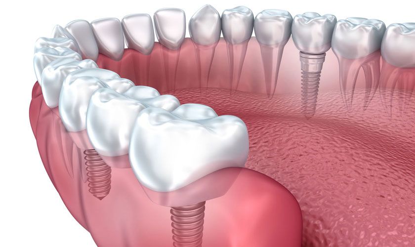 Những lưu ý về mô mềm trước khi trồng răng Implant