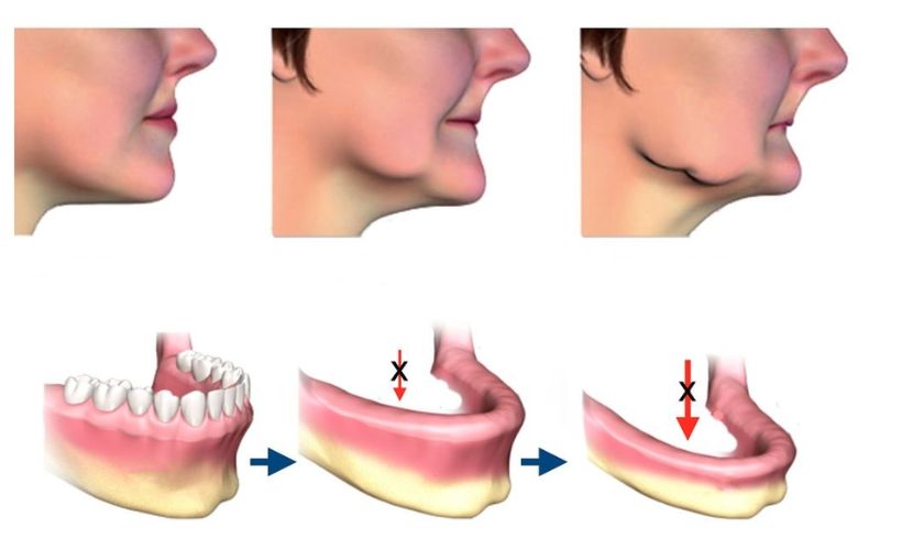 Tiêu xương hàm khi bị mất răng số 6