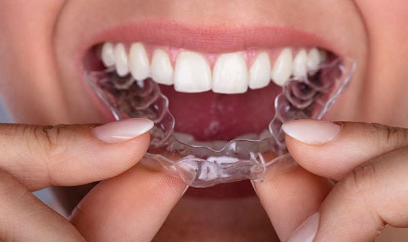 Niềng răng trong suốt Invisalign giúp dễ dàng vệ sinh tháo lắp