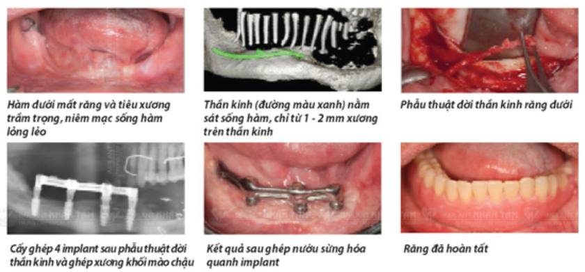 Phẫu thuật dời dây thần kinh hàm dưới và cấy ghép Implant cho người không răng bẩm sinh đánh dấu bước phát triển vượt bậc của Implant Việt Nam Phẫu thuật dời dây thần kinh hàm dưới và cấy ghép Implant cho người không răng bẩm sinh đánh dấu bước phát triển vượt bậc của Implant Việt Nam