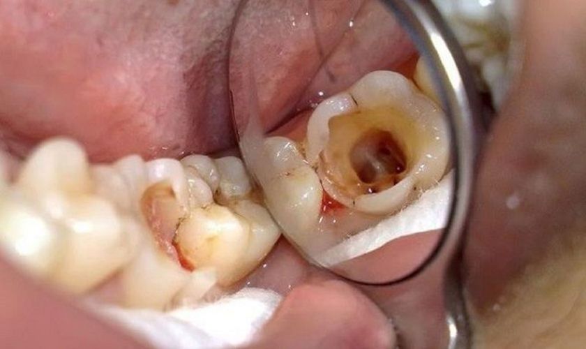 Không điều trị các bệnh lý răng miệng trước khi cấy ghép Implant gây ra tình trạng răng Implant bị viêm