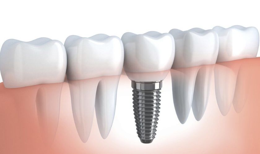 Lựa chọn trụ Implant không phù hợp gây ra tình trạng răng Implant bị viêm