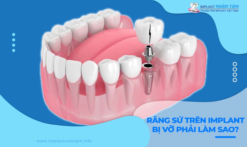 Nguyên nhân, biện pháp khắc phục răng sứ trên Implant bị vỡ