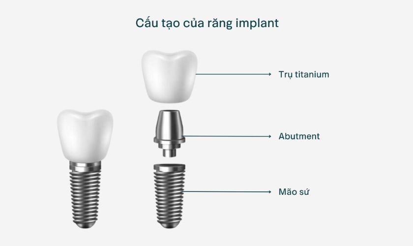 Răng Implant gồm 3 bộ phận chính: trụ Implant, mão răng sứ và khớp nối abutment