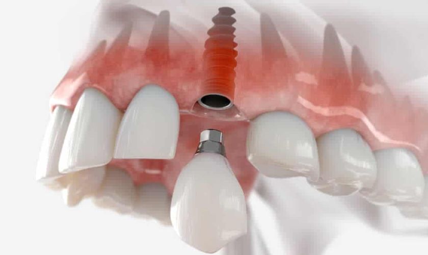 Răng sứ trên Implant bị vỡ cần được tháo trụ Implant ra khỏi xương hàm