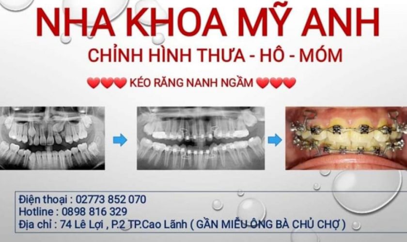 Nha khoa Mỹ Anh nổi bật với dịch vụ chỉnh răng thưa - hô - móm