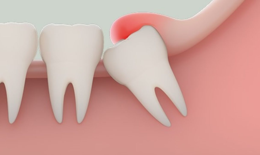 Trường hợp sưng mộng răng khôn