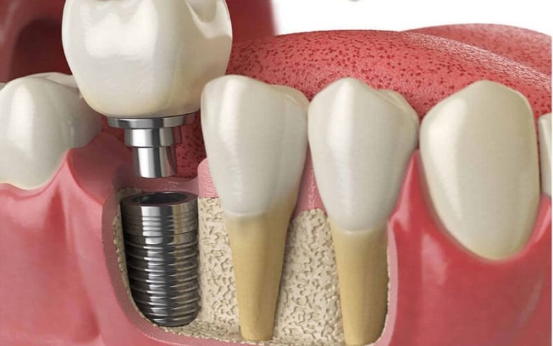 So sánh trồng răng implant xi măng (Ciment) và bắt vít (SSI)