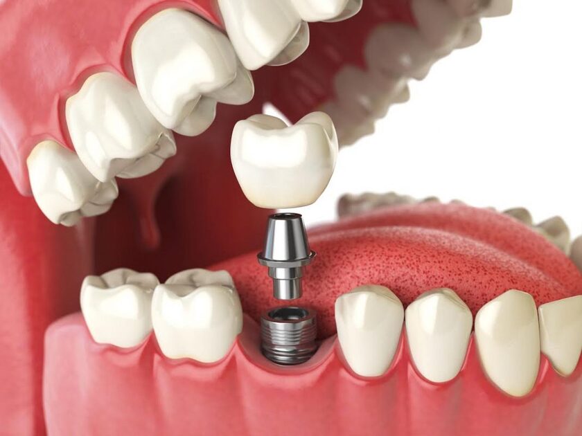 Trồng răng implant bắt vít là phương pháp phục hình răng mất tối ưu nhất hiện nay